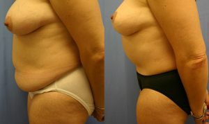Patient 12c Tummy Tuck Before and After