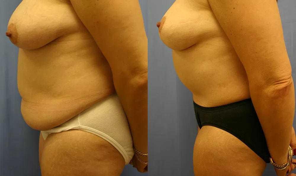 Patient 12c tummy tuck before and after