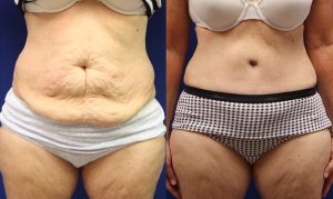 Patient 17b Tummy Tuck Before and After