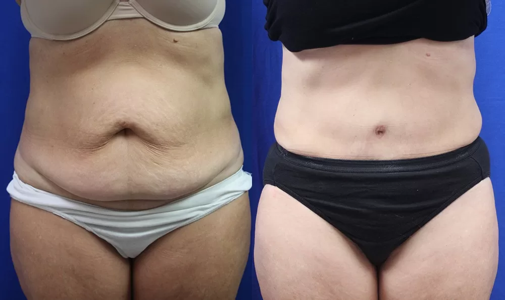 Patient 11a tummy tuck before and after