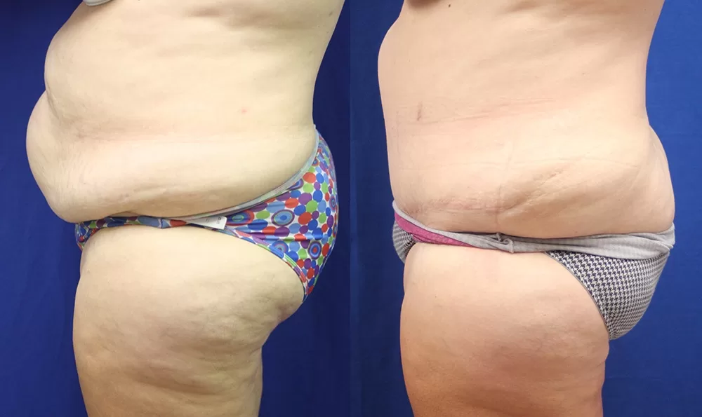 Patient 16b tummy tuck before and after