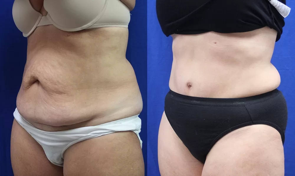 Patient 11b tummy tuck before and after