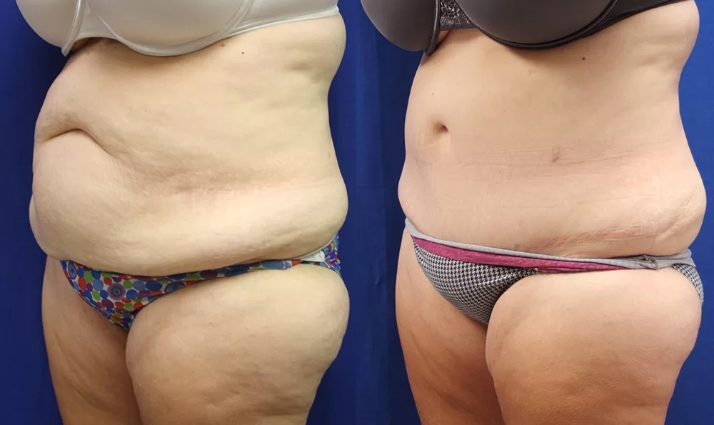 Patient 16c tummy tuck before and after