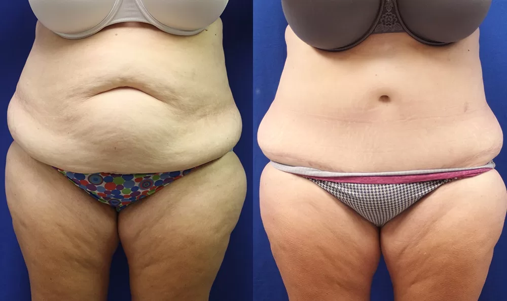 Patient 16a tummy tuck before and after