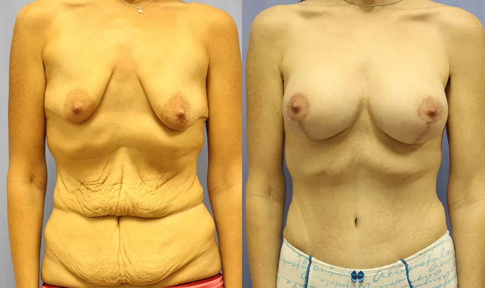 Patient 10a tummy tuck before and after