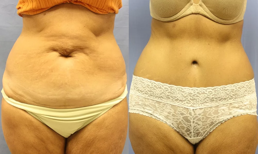 Patient 15a tummy tuck before and after