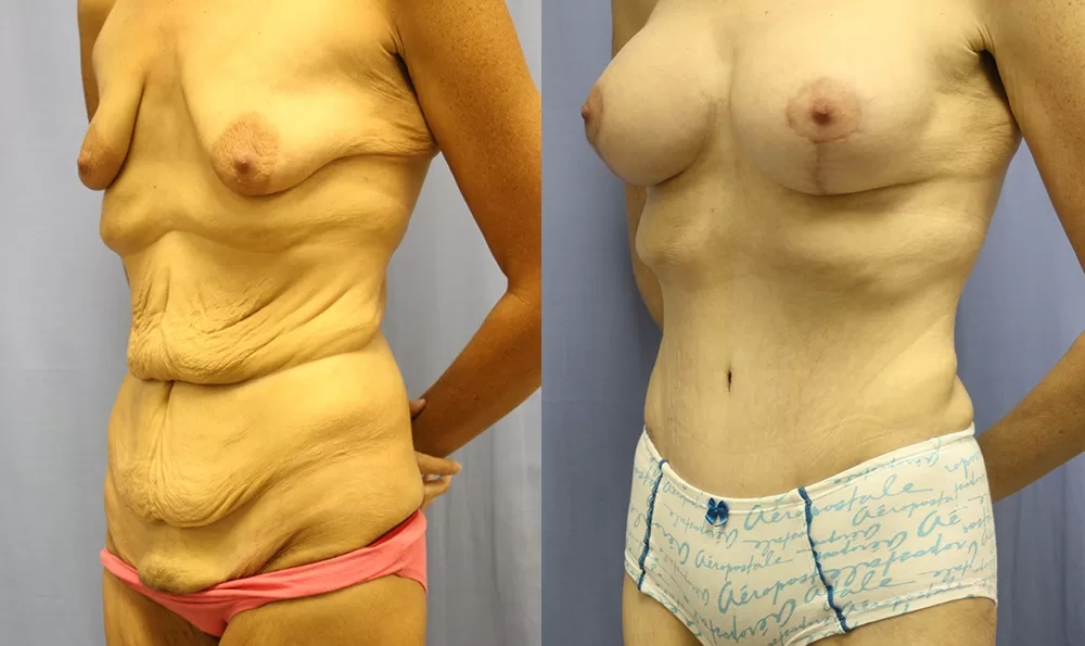 Patient 10b tummy tuck before and after