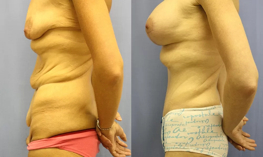 Patient 10c tummy tuck before and after
