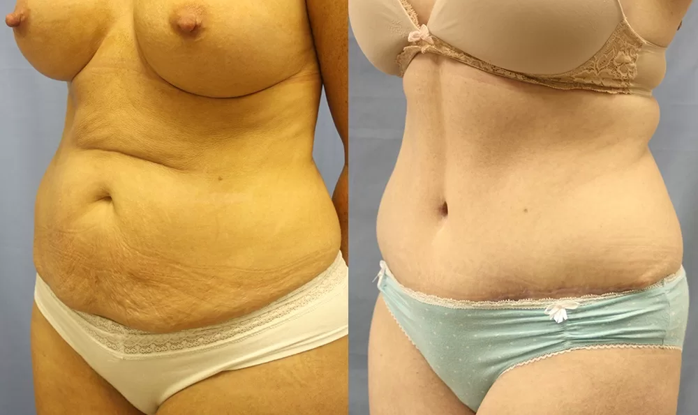 Patient 14b tummy tuck before and after