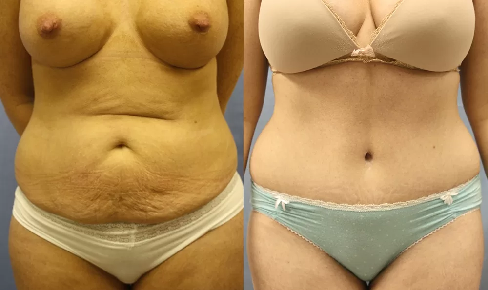 Patient 14a tummy tuck before and after
