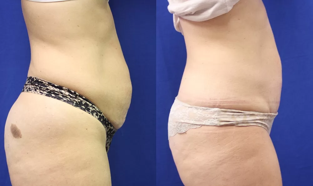 Patient 13b tummy tuck before and after