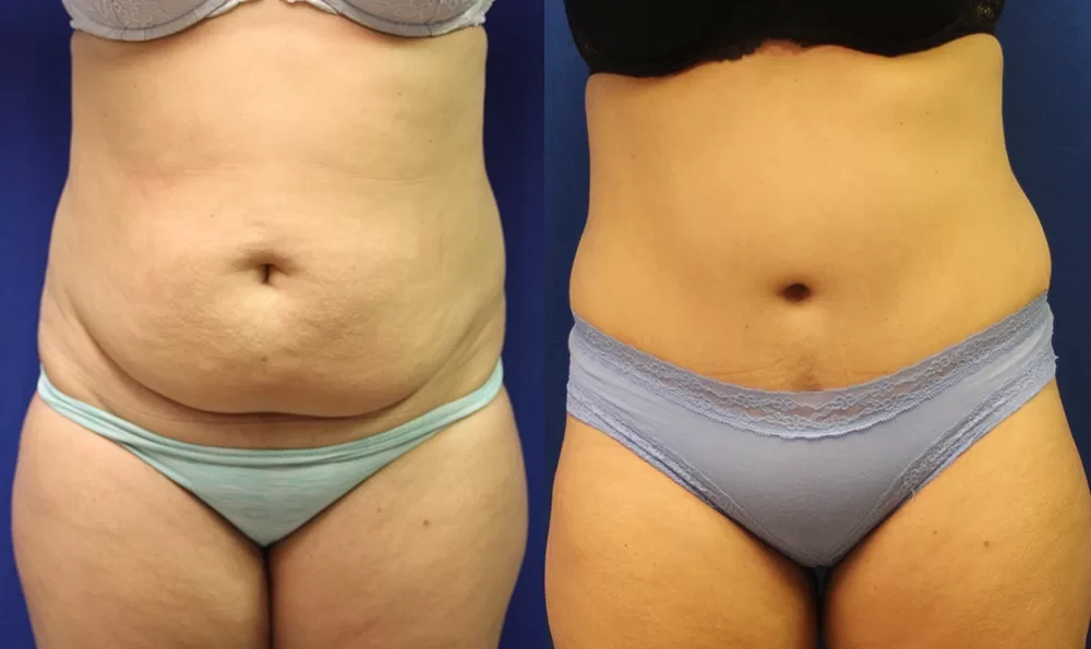 Patient 9a tummy tuck before and after