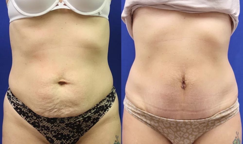 Patient 13a tummy tuck before and after