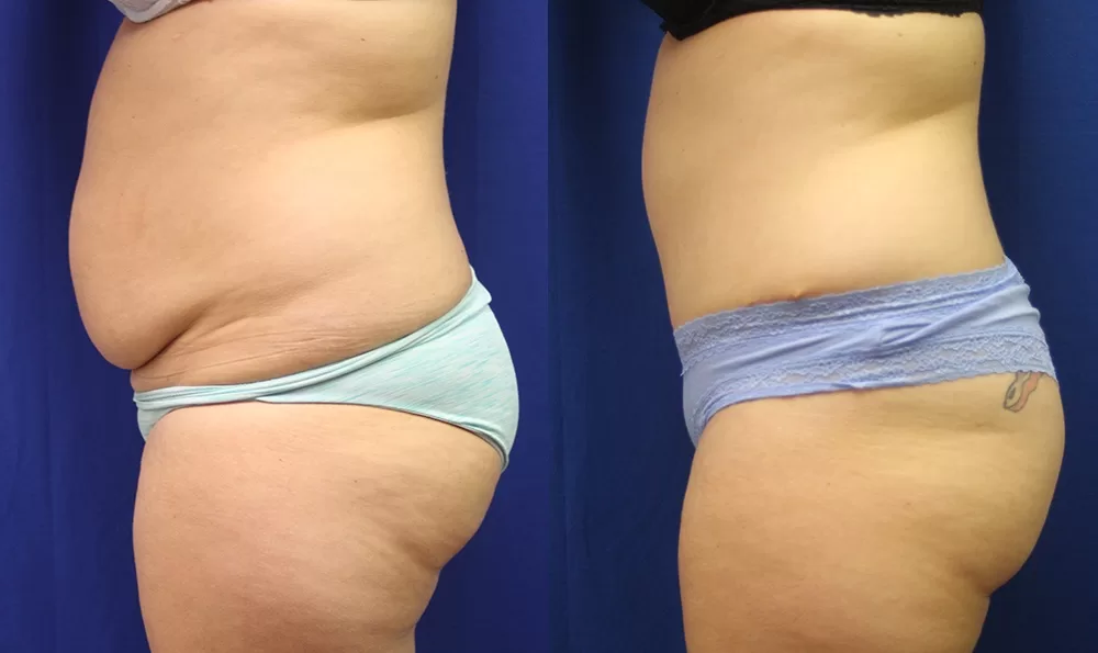 Patient 9b tummy tuck before and after