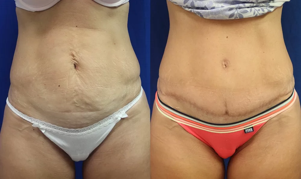 Patient 8a tummy tuck before and after