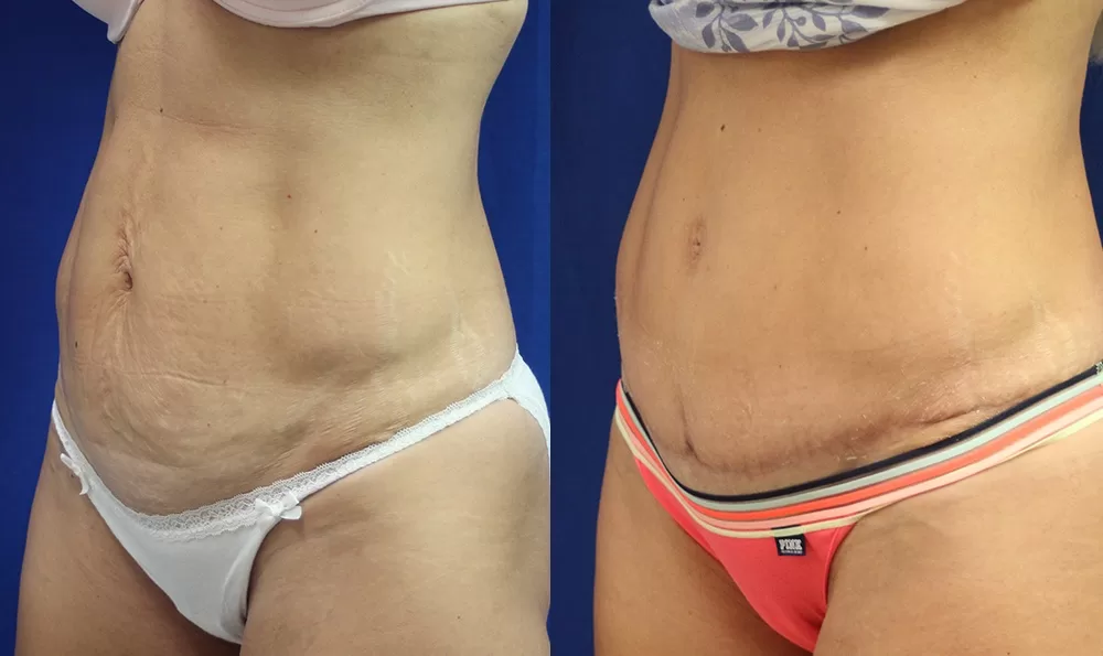 Patient 8b tummy tuck before and after