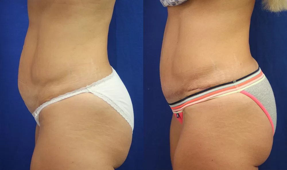 Patient 8c tummy tuck before and after