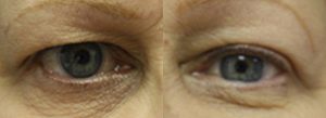 Patient A Blepharoplasty Before and After