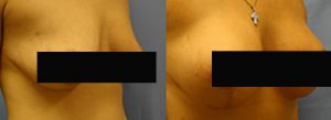 Patient A Breast Lift Before and After