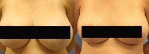 Patient A Breast Reduction Before and After