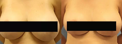 Patient a breast reduction before and after | moraitis plastic surgery Patient a breast reduction before and after