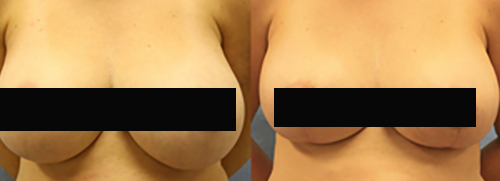 Pacienta A Breast Reduction Before and After