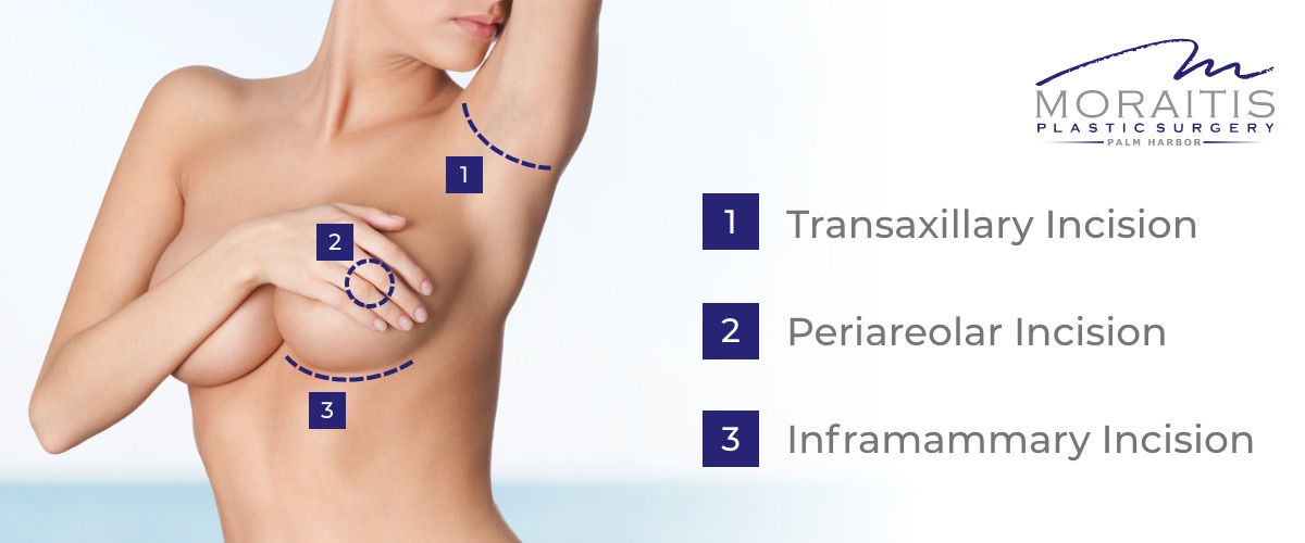 moraitis incision types