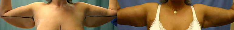 Patient 2 arm lift before and after