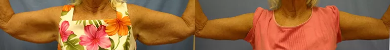 Patient 1 arm lift before and after