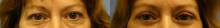 Patient 2 blepharoplasty before and after