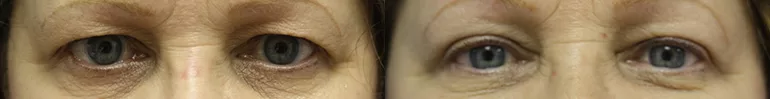 Patient 1 blepharoplasty before and after