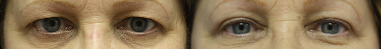 Patient 1 Blepharoplasty Before and After