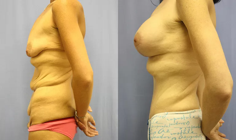 Patient 3a body lift before and after