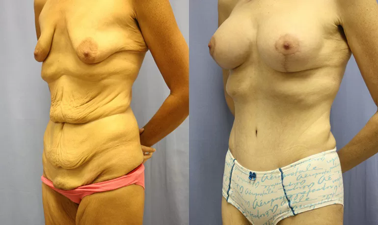 Patient 3b body lift before and after