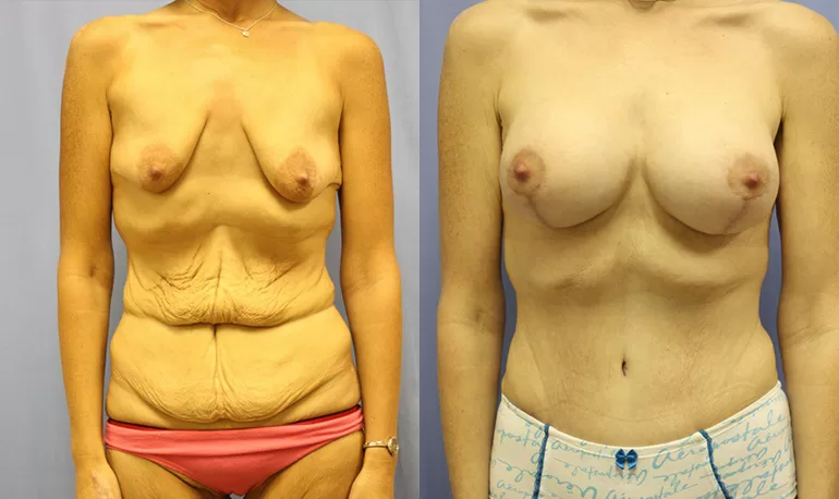Patient 3c body lift before and after