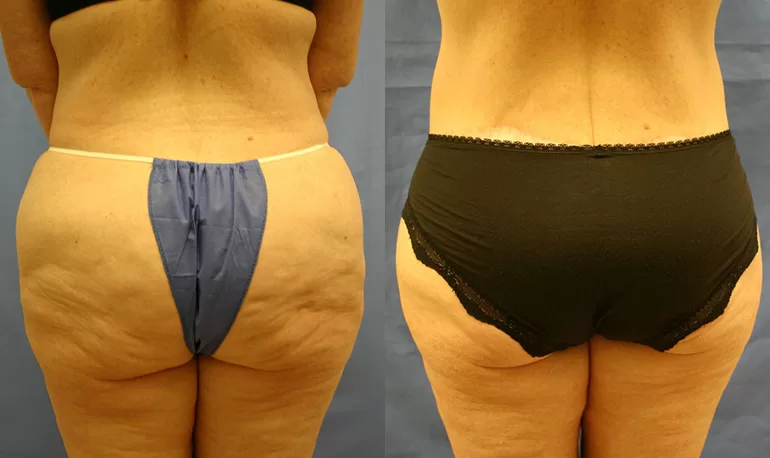 Patient 4a body lift before and after
