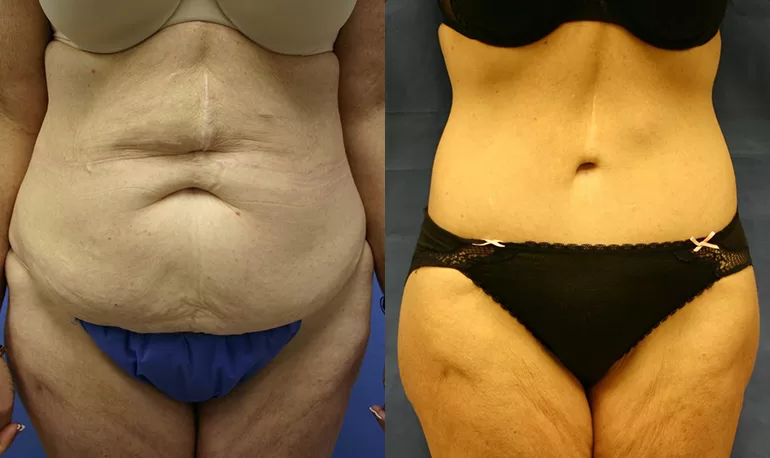 Patient 4b body lift before and after