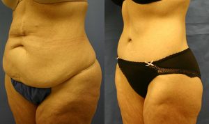 Patient 4c Body Lift Before and After