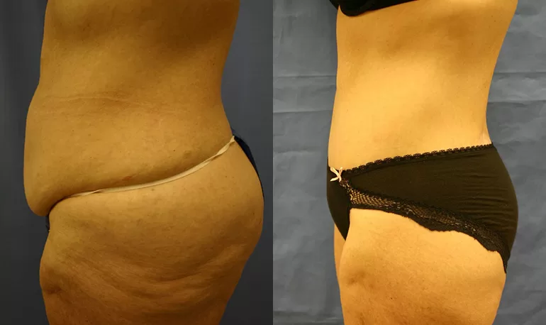 Patient 4d body lift before and after