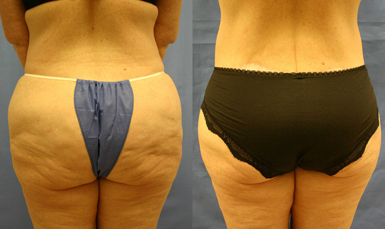 Patient 4a Body Lift Before and After