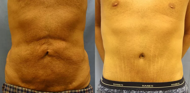 Patient 1a body lift before and after
