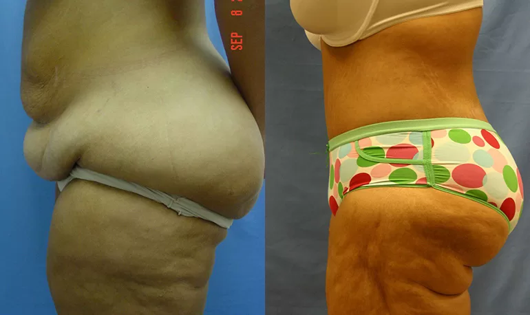 Patient 2a body lift before and after