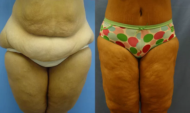 Patient 2b body lift before and after