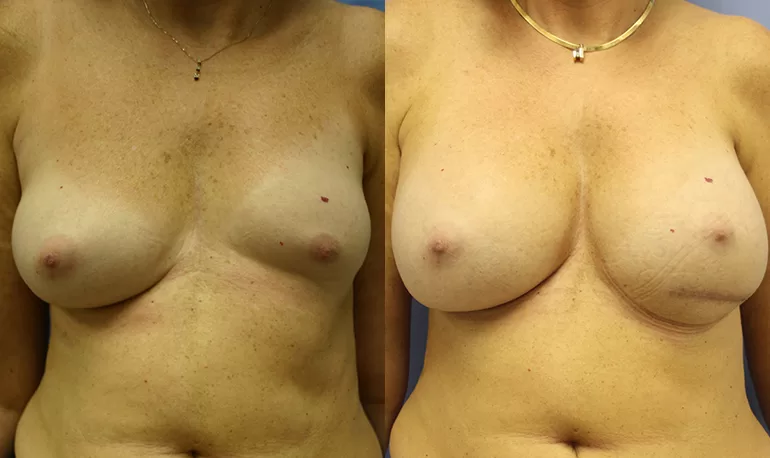 Patient 1a breast asymmetry before and after