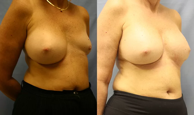 Patient 1b breast asymmetry before and after