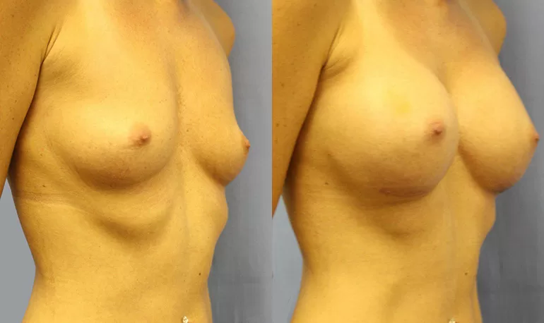 Patient 6b breast augmentation before and after