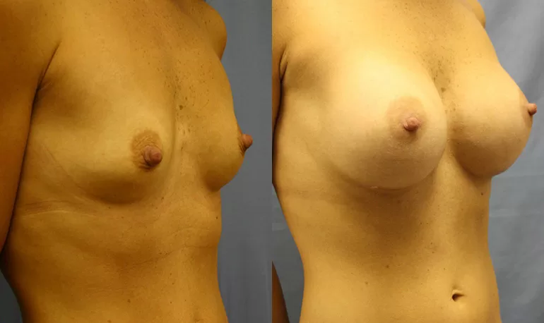 Patient 7b breast augmentation before and after