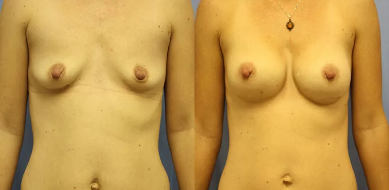Patient 9a breast augmentation before and after