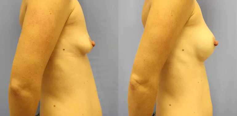 Patient 9b breast augmentation before and after