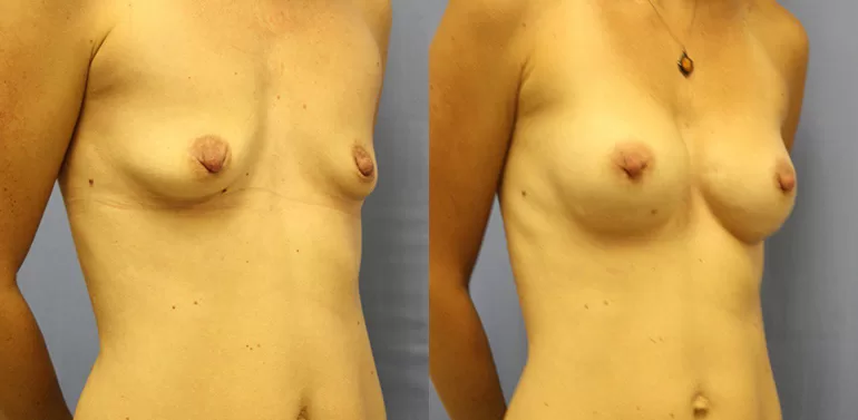 Patient 9c breast augmentation before and after